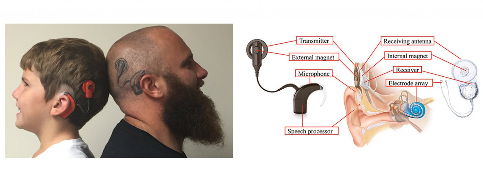 Cochlear Implant SDM Co., Ltd.